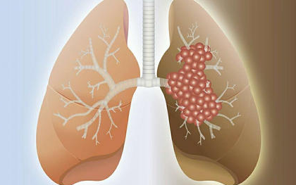 在现代已有的研究证明中，肺癌与长期大量吸烟有何关系？